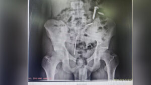 Ngeri! Paku dan Koin Ditemukan di Dalam Tubuh ODGJ Asal Puger Jember